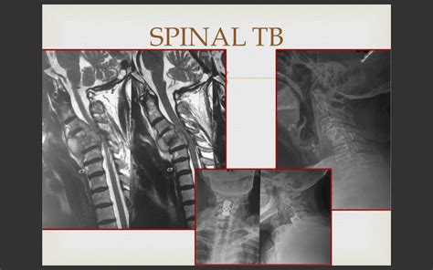 Revision Spine Surgery Treatement in Delhi India | Dr Saurabh Rawall