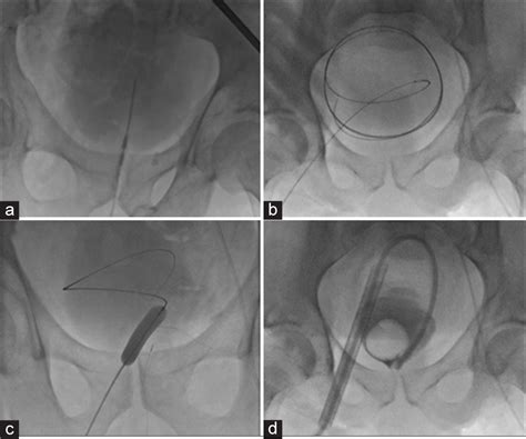 Imaging-guided Percutaneous Large-Bore Suprapubic Cystostomy, a Safe ...