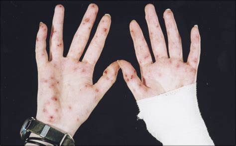 Rat bite fever - The Lancet Infectious Diseases