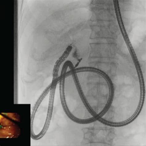 Roux-en-Y reconstruction without gastrectomy. A short-type SBE could ...