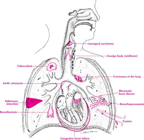 Hemoptysis - Differential Diagnosis in Primary Care, 4th Edition