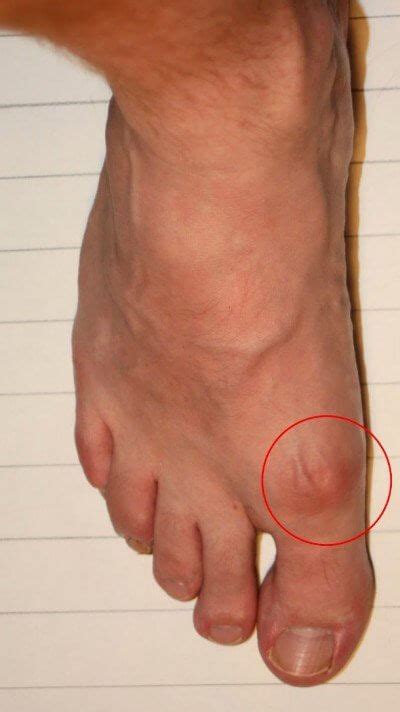 diagnosis - gout v.podagra v. hallux - Your Gout Friend