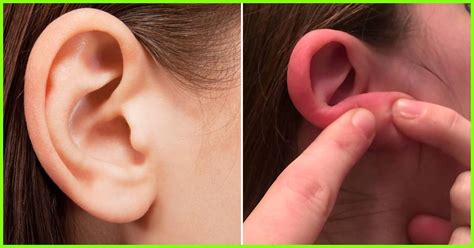 Pimples Behind The Ears: 6 Home Remedies And Causes