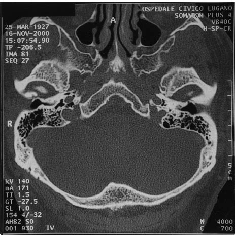 Computed tomographic scan of petrous temporal bone 6 months after ...