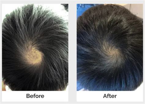 Expert Alopecia Areata Treatment | Svenson