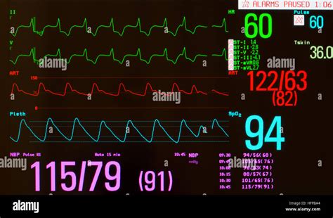 Monitor showing ECG with paced heart rhythm, arterial blood pressure ...