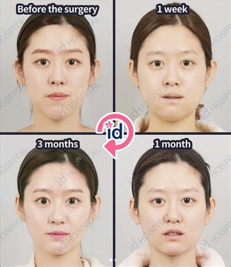 Orthognathic surgery in Korea. Before & After | Orthognathic surgery, Plastic surgery, Plastic ...