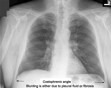 Thorax Radiologic Anatomy