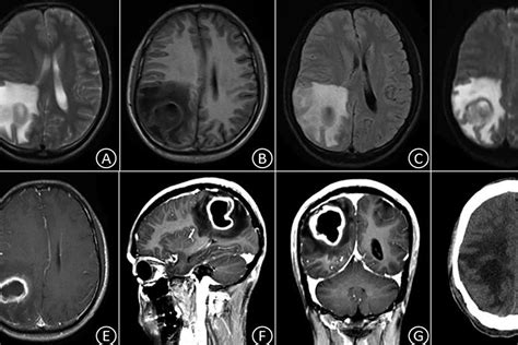 Brain Abscess | Symptoms, Diagnosis & Treatment - Pure Medical