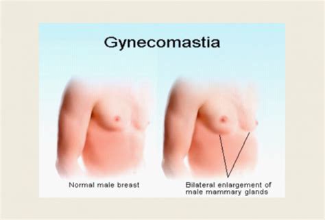 Gynecomastia - Causes,Signs & Symptoms and Treatment : MEDICUS