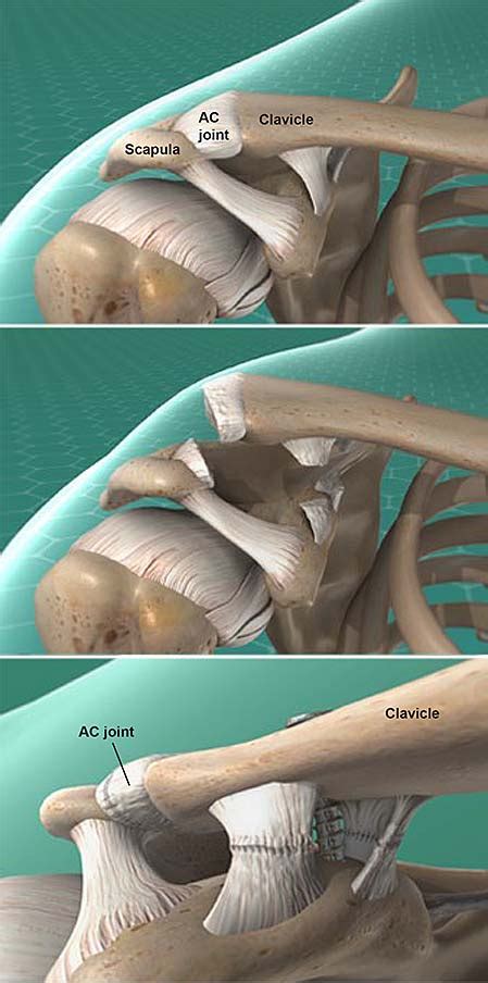 Acromioclavicular (AC) Joint Separation Repair | Central Coast ...