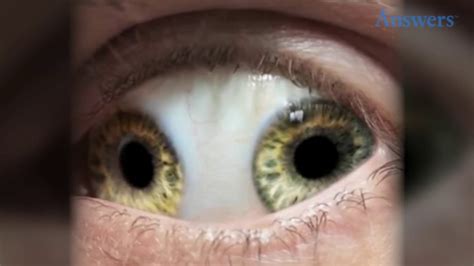 Rare Eye Conditions You Have To See To Believe | Doovi