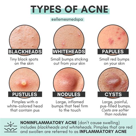 i have like cysts please what can be the solution : r/AusSkincare