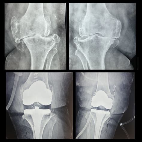 Single-Stage Bilateral Total Knee Replacement Surgery Success - Knee, Shoulder & Hip Surgeon ...