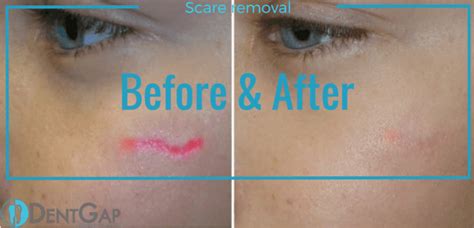 Laser Scar Removal: Facts, Cost, Does it work?