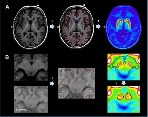 Dopamine transporter imaging with [18F]FE-PE2I PET and [123I]FP-CIT SPECT—a clinical comparison ...