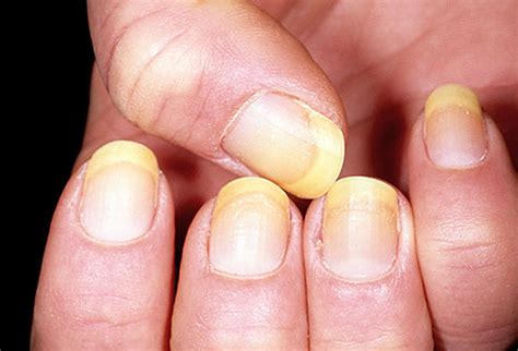 White fingernails and liver disease - Awesome Nail