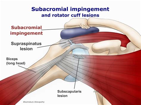 Impingement of the shoulder SHOP02 - Bloomsbury Health Centre