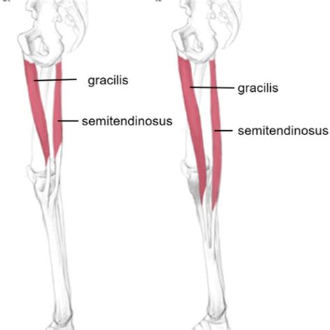 Ultrasound was used to explore the left semitendinosus tendon at the... | Download Scientific ...