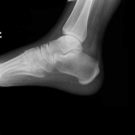 X-ray Left Heel Lateral | Test Price in Delhi | Ganesh Diagnostic