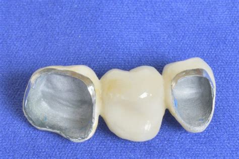 PFM Restorations » Tigard, OR - Appletree Dentistry