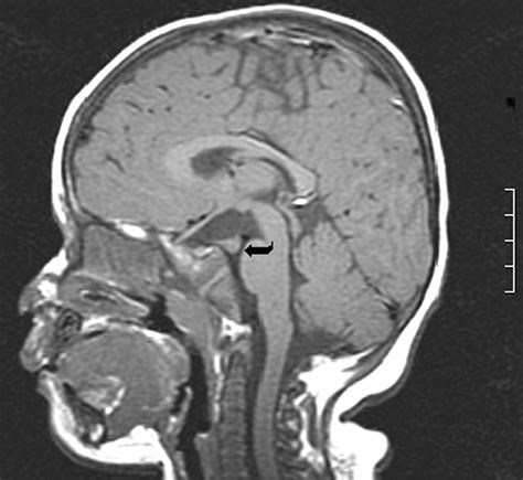 Pre- and Postnatal MR Imaging of Hypothalamic Hamartomas Associated ...