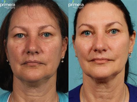 Eyelid surgery | Blepharoplasty | Botox in Orlando