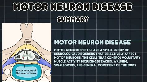 Motor neuron disease (Medical Condition) - YouTube