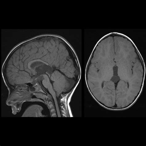 Cavum Velum Interpositum | Pediatric Radiology Reference Article ...