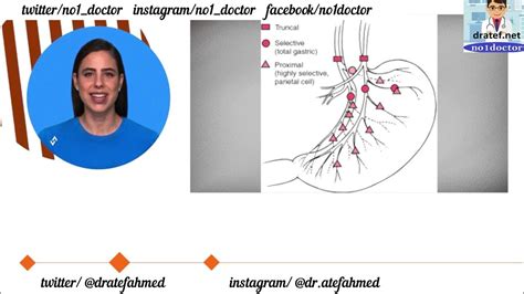 Vagotomy /Types/Indications/Surgery/Laparoscopic/complications/Techniques/Peptic Ulcer ...