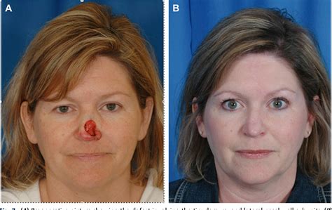 Paramedian Forehead Flap Before And After