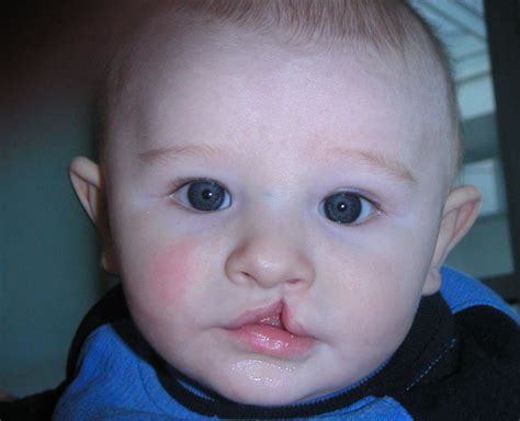 Cleft Lip Causes Symptoms Diagnosis and Treatment By Expert | cleft lip causes symptoms ...