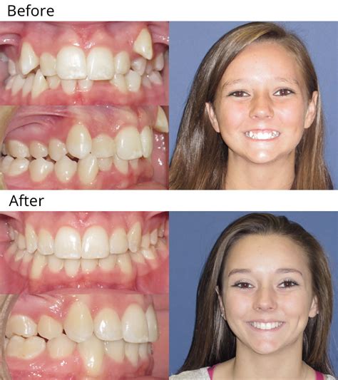 Before and After Gallery - West Temple Orthodontics | Temple TX