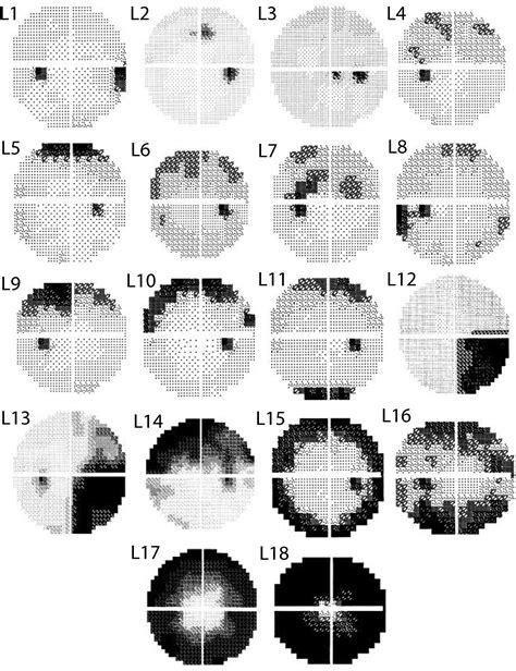 Machine-Identified Patterns of Visual Field Loss and an Association ...