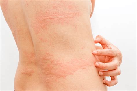 Skin Rashes : Facts, types, causes, complications, & treatment | FactDr