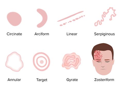 Exantemas Generalizados e Localizados | Concise Medical Knowledge