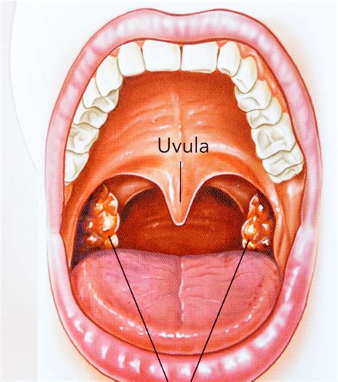 Tonsil Viral Infection