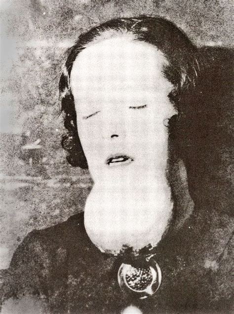 'Radium Girl' - A dial painter who suffered from a radium-induced sarcoma of the chin c.1920's ...