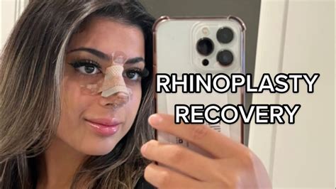 Rhinoplasty Recovery Q&A - YouTube