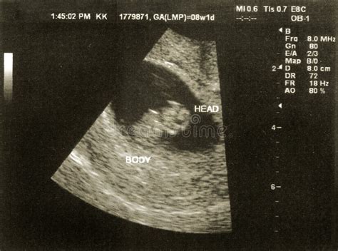 Ultrasound Of A Fetus At 8 Weeks 1 Day Royalty Free Stock Photos - Image: 13907748