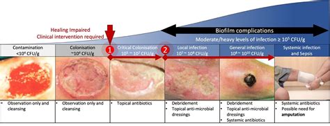 Ozone as a Topical Treatment for Infected Dermal Wounds