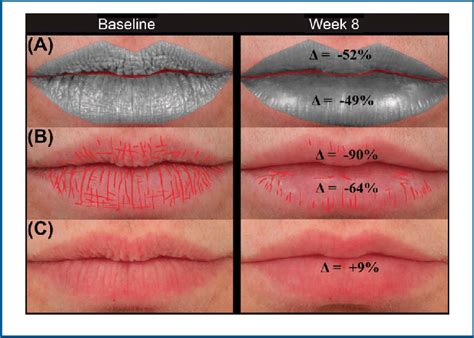 Lip texture of a 51-year-old subject treated with 0.9 mL and 0.55 mL HA ...