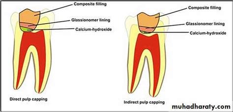 Mta Pulp Capping / Direct And Indirect Pulp Capping A Brief History ...