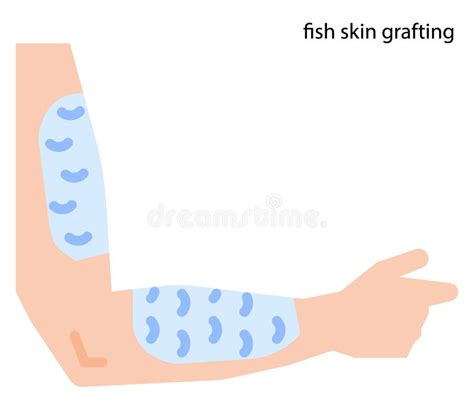 Fish Skin Grafting for Wound Healing Stock Photo - Image of fishskin, skin: 271815688