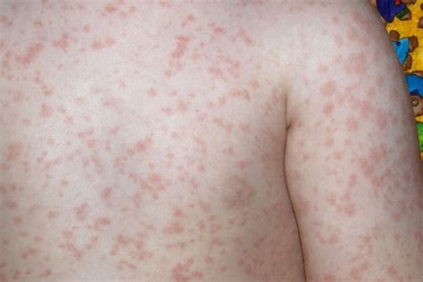 Fifths Disease Rash In Adults