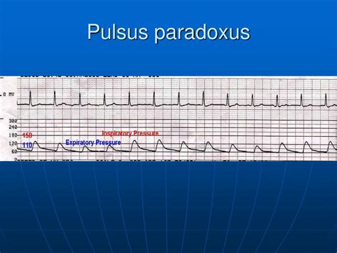 PPT - Invasive blood pressure monitoring in critical care PowerPoint ...