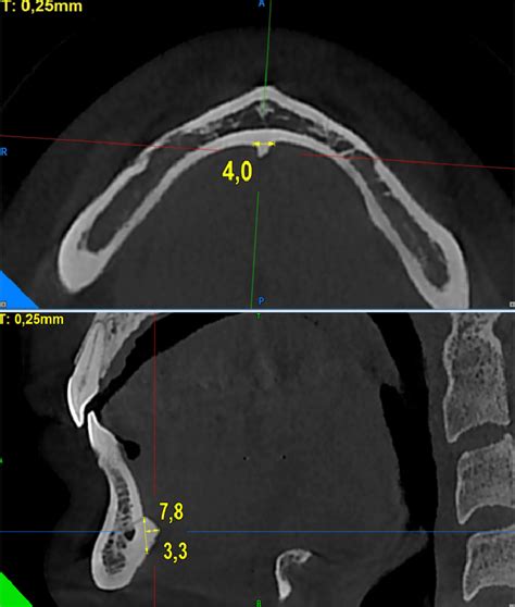 Measurement of the genial tubercle in the axial, horizontal and ...