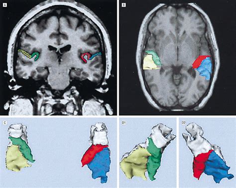 Planum Temporale and Heschl Gyrus Volume Reduction in Schizophrenia: A Magnetic Resonance ...