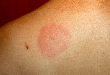 Lyme Disease - Tiny Ticks, Huge Problems - Skin Site