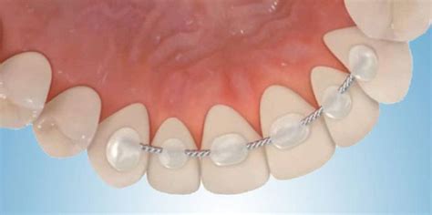 Bonded Retainers | Orthodontist in Davenport & Celebration, FL